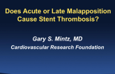 Does Acute or Late Malapposition Cause Stent Thrombosis?