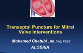 Transeptal Puncture for Mitral Valve Interventions: Indications and Techniques