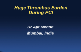 Huge Thrombus Burden During PCI