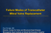 Failure Modes for Transcatheter MV Replacement and Their Implications: Paravalvular Leaks, LVOT, Embolization, and More