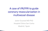 Spain Presents: A Case of iFR-FFR to Guide Coronary Revascularization in Multivessel Disease