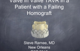 Bioprosthetic Aortic Valve Failure and TAVR: Case Presentation