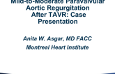 Mild-to-Moderate Paravalvular Aortic Regurgitation After TAVR: Case Presentation