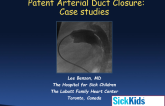 Two Illustrative Cases of PDA Closure: One Simple and One Large and Complex