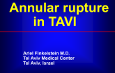 Presentation From Israel: Annular Rupture During TAVI