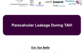 Presentation From France: Paravalvular Leakage During TAVI