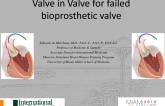 Valve in Valve for Failed Bioprosthetic Valve
