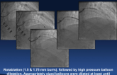 Case #2 (From Indonesia): Bioresorbable Scaffold for Treatment of Highly-Calcified Diffuse Stenosis: How Did I Treat?