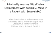 TCT 1600: Minimally Invasive Mitral Valve Replacement With Sapien S3 Valve in a Patient With Severe MAC