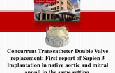 TVT 1036: Concurrent Transcatheter Double Valve Replacement: First Report of Sapien 3 Implantation in Native Aortic and Mitral Annuli in the Same Setting