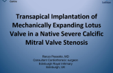 TVT 1035: Transapical Implantation of Mechanically Expanding Lotus Valve in a Native Severe Calcific Mitral Valve Stenosis