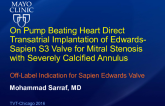 TVT 1126: On-Pump Beating-Heart Direct Transatrial Implantation of Edwards Sapien 3 Valve for Mitral Stenosis With Severely Calcified Annulus