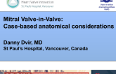 TAVR in Mitral Valve Bioprothesis (VIV): Anatomical Considerations