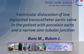 TVT 1092: Ventricular Dislocation of Low-Implanted Transcatheter Aortic Valve in a Patient With Porcelain Aorta and a Narrow Sinotubular Junction