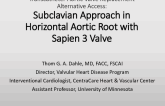 TVT 1148: Supraclavicular Subclavian Access for Sapien Transcatheter Aortic Valve Replacement in a Horizontal Aorta