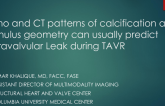 Echo and CT Patterns of Calcification and Annulus Geometry Can Usually Predict PVR During TAVR