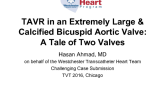 TVT 1080: TAVR in an Extremely Large and Calcified Bicuspid Aortic Valve  A Tale of Two Valves