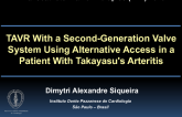 TVT 1115: TAVR With a Second-Generation Valve System Using Alternative Access in a Patient With Takayasu's Arteritis