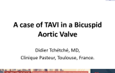 Anatomy of Bicuspid Aortic Valve