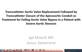 TVT 1055: Transcatheter Aortic Valve Replacement Followed by Transcatheter Closure of the Apicoaortic Conduit as Treatment for Failing Apicoaortic Conduit in a Patient With Severe Aortic Stenosis