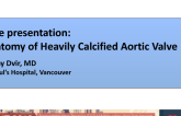 Anatomy of Heavily Calcified Aortic Valve