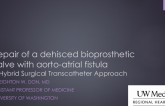 TVT 1180: Surgical Placement of a TAVR Valve to Treat an Aortoatrial Fistula, an Annular Abscess, and Severe Regurgitation in a Dehisced Bioprosthetic Valve
