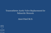 TVT 1059: Transcatheter Aortic Valve Replacement for the Treatment of Subaortic Stenosis