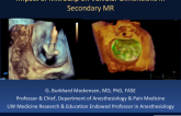 Impact of MitraClip on Vavlular Dimensions in Secondary MR