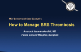 How to Manage BRS Thrombosis (With Case Examples)
