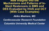 New Insights Into the Mechanisms and Patterns of in-stent Restenosis in BMS and DES Evaluated By IVUS and OCT (With Case Examples)