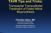 Case #4: Transseptal Transcatheter Treatment of Failed Mitral Bioprosthesis (With Tips and Tricks)