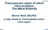 Transvascular Repair of Mitral Valve Prolapse: The Mitral Butterfly