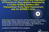 TCT 38: Paravalvular Regurgitation Regression and Impact on One-Year Outcomes After Transcatheter Aortic Valve Replacement With the SAPIEN 3 Transcatheter Valve