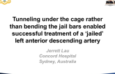 Tunnelling Under the Cage, Rather Than Bending the Jail Bars, Enabled Successful Treatment of a Jailed Left Anterior Descending Artery
