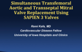 TCT 1524: Simultaneous Transfemoral Aortic and Transseptal Mitral Valves Replacement Utilizing Sapien 3 Valves in Native Aortic and Mitral Valves