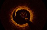 ILUMIEN 3: OCT Imaging Matches IVUS but Fails To Beat Angiography for Stent Guidance in PCI