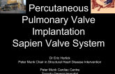 Transcatheter Pulmonary Valve Replacement 2: Sapien