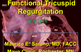 Impact and Natural History of Functional Tricuspid Regurgitation