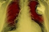 Conduction Problems Requiring Permanent Pacemakers Continue to Vex TAVR Field