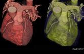 CT Angiography Moves to Forefront in Assessment of Chest Pain in UK