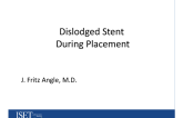 Dislodged Stent During Placement