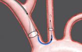 FDA Advisors Positive on Sentinel Cerebral Protection Device in TAVR 