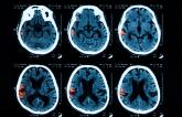 Restarting Oral Anticoagulation After Intracerebral Hemorrhage Tied to Better Outcomes
