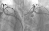 Rate of Incomplete Revascularization During PCI Is Highly Variable Across Operators