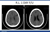 Imaging of Acute Stroke: What You Need to Make a Decision to Treat