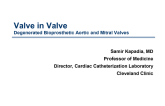 Valve-in-Valve: What You Need to Know