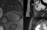 CMR Perfusion Imaging Holds Its Own Against Invasive Approach to Managing Stable Angina