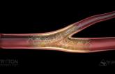 FDA Gives Thumbs Up to Side Branch Stent for Bifurcation Lesions
