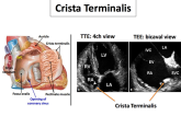  Live Dissection Valvular Heart Disease: Tricuspid and Pulmonic Valve