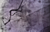 Benefits of FFR-Guided Complete Revascularization in STEMI May Be Limited to Most Severe Disease